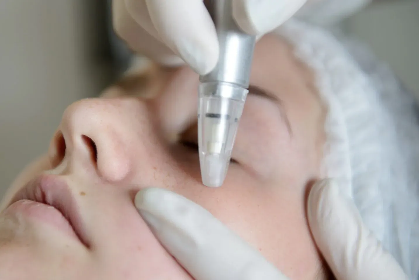 Close-up of clinician in gloves performing RF microneedling on patient's face during skin rejuvenation treatment.